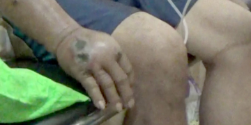 Pasien yang diduga terjangkit Antraks, di rujuk ke rumah sakit, guna mendapatkan penanganan lebih lanjut. Foto: Lukman Polimengo.